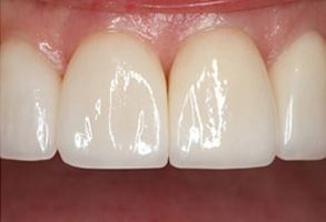 Astoria Dentistry | Ceramic Crowns, ZOOM  Whitening and Veneers
