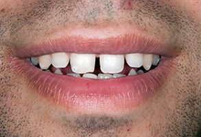 Astoria Dentistry | Dental Bridges, Teeth Whitening and Implant Restorations