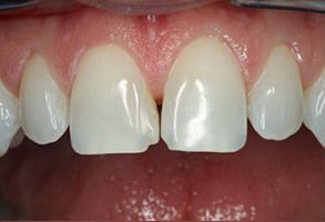 Astoria Dentistry | Teeth Whitening, Implant Restorations and Cosmetic Dentistry